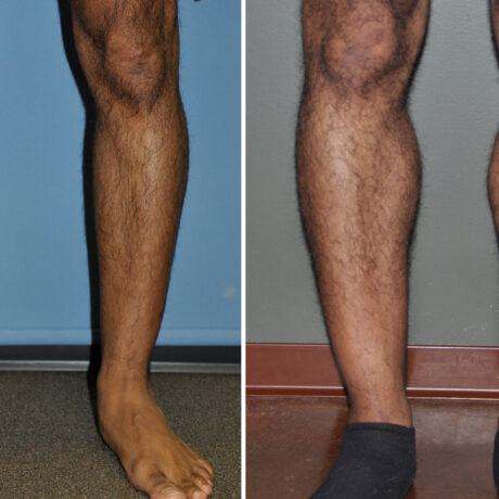 Calf Implant