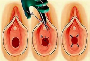 Hymenoplasty