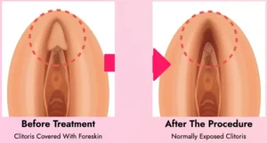 Clitoral Enlargement Surgery