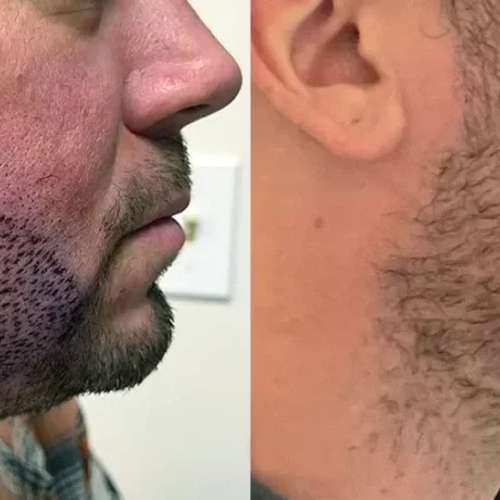 Beard Transplant