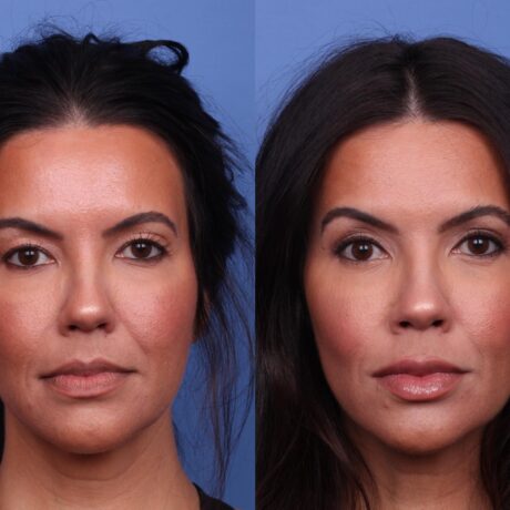 Blepharoplasty