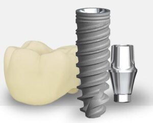 Conventional Implant