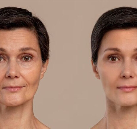 Facelift Surgery