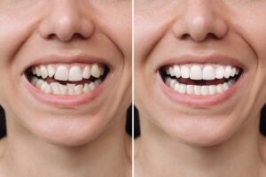 Invisalign