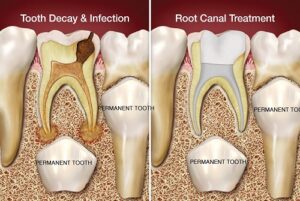Root Canal Therapy