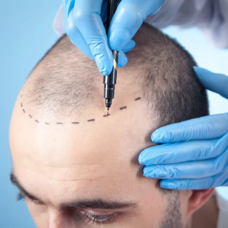 Hair Transplant