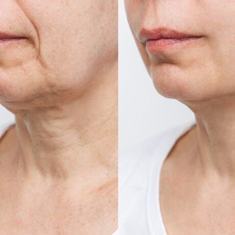 Neck Lift