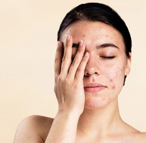 Acne Scar Treatment