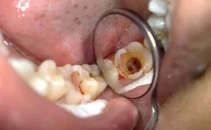 Pulpectomy