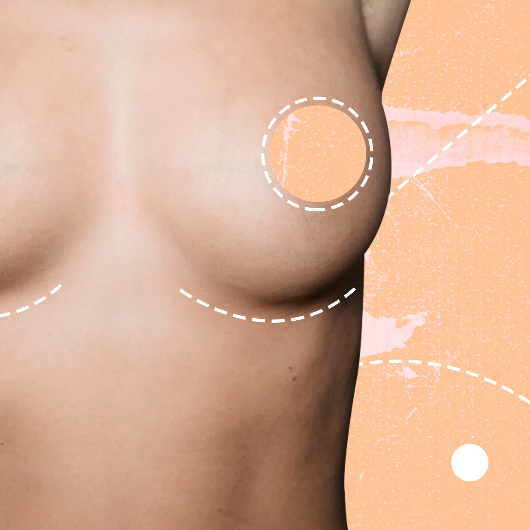 Breast Implant