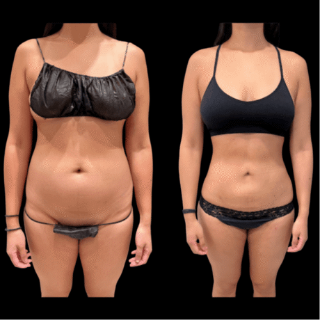 360 Liposuction